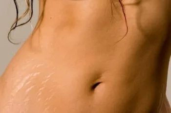 stretch_marks Stretch Mark Removal Options